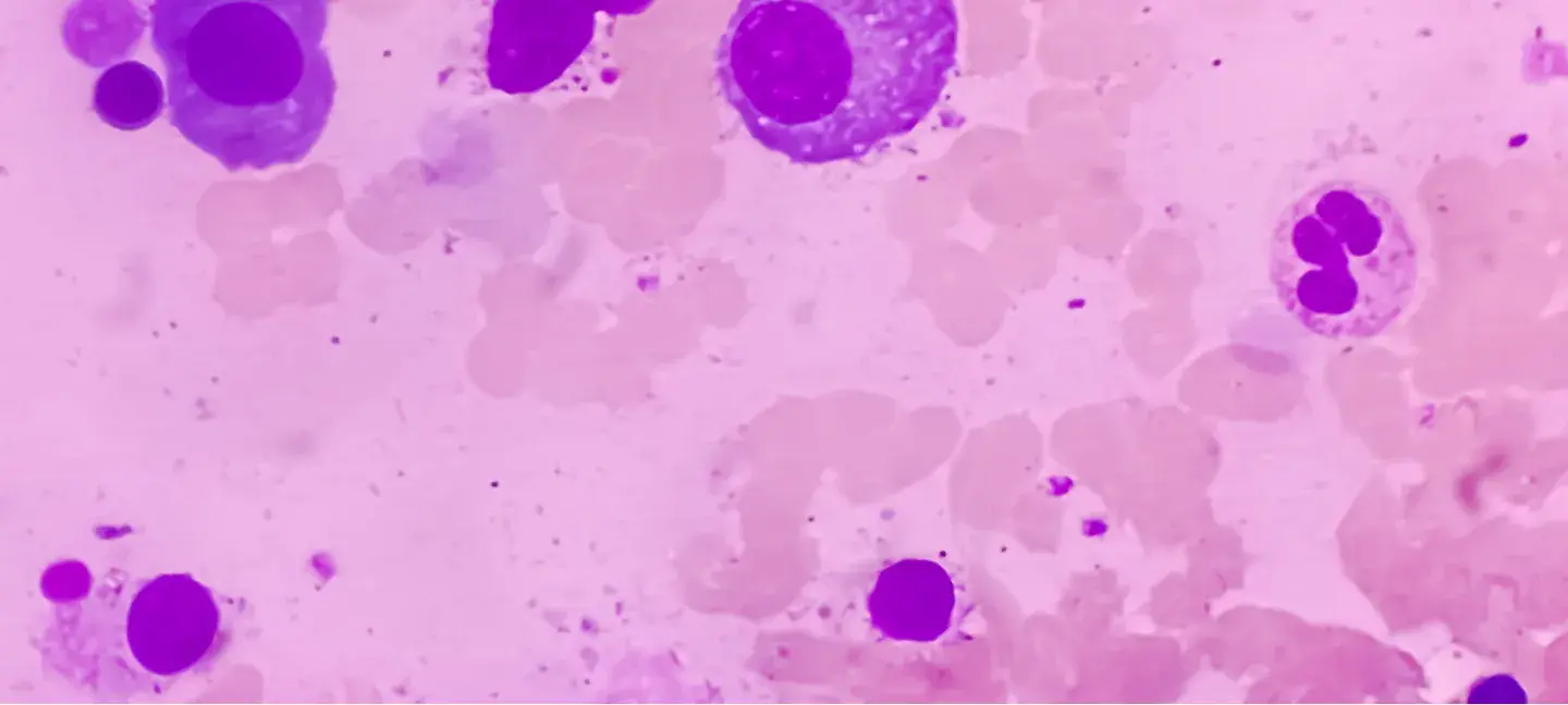 Multipel myeloom - Onderzoek