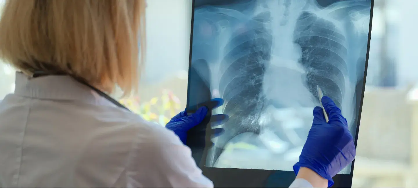 Longziekte - Longen - Rontgen