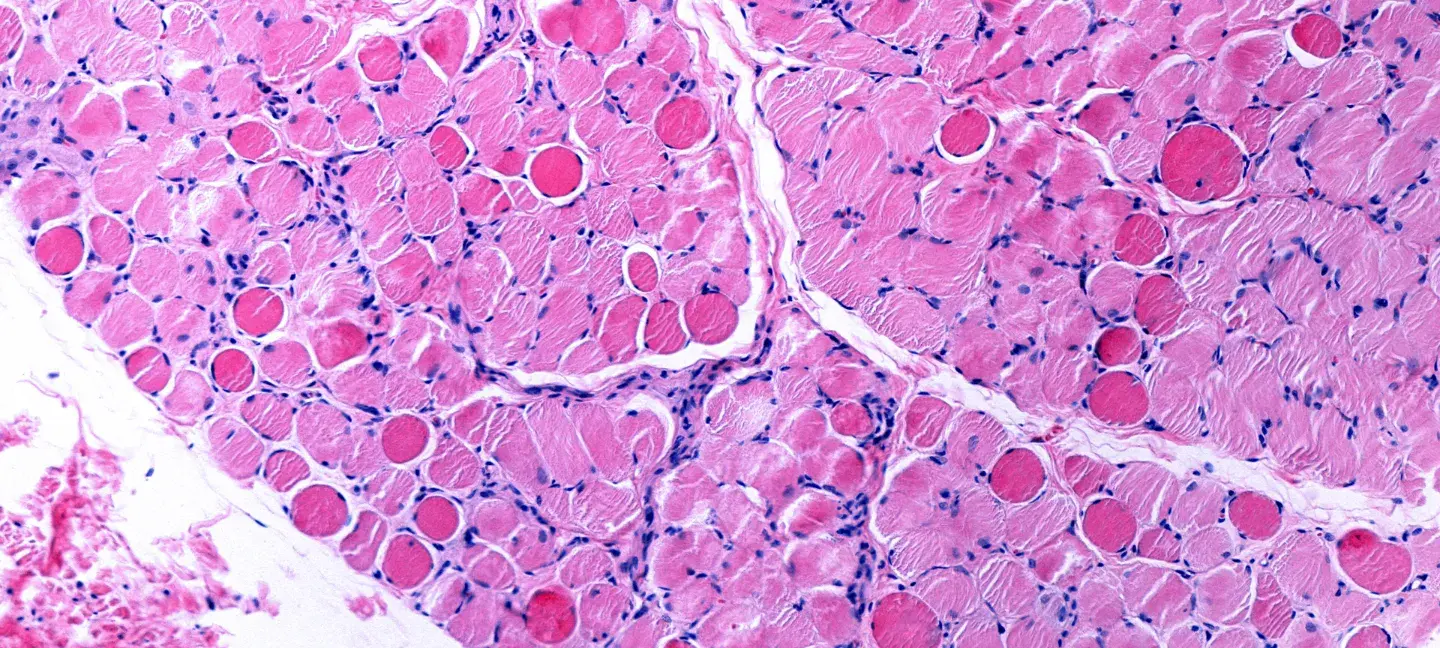 Duchenne - Onderzoek