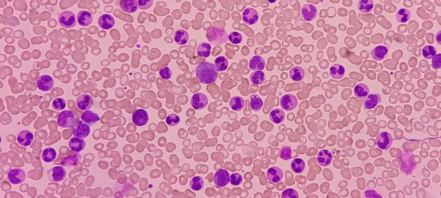 Leukemia