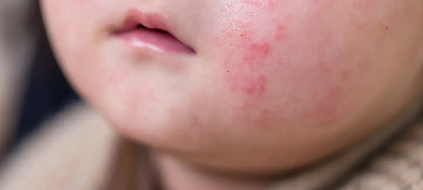 Allergie - Zuigelingenallergie - Baby